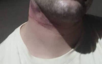 Perigo: Entregador de Santo Ângelo Sofre Lesões no Pescoço devido a Fios Solto em Avenida Principal